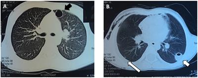 A Novel STAT3 Mutation in a Qatari Patient With Hyper-IgE Syndrome